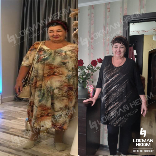 Gastric bypass surgery Before / After photo